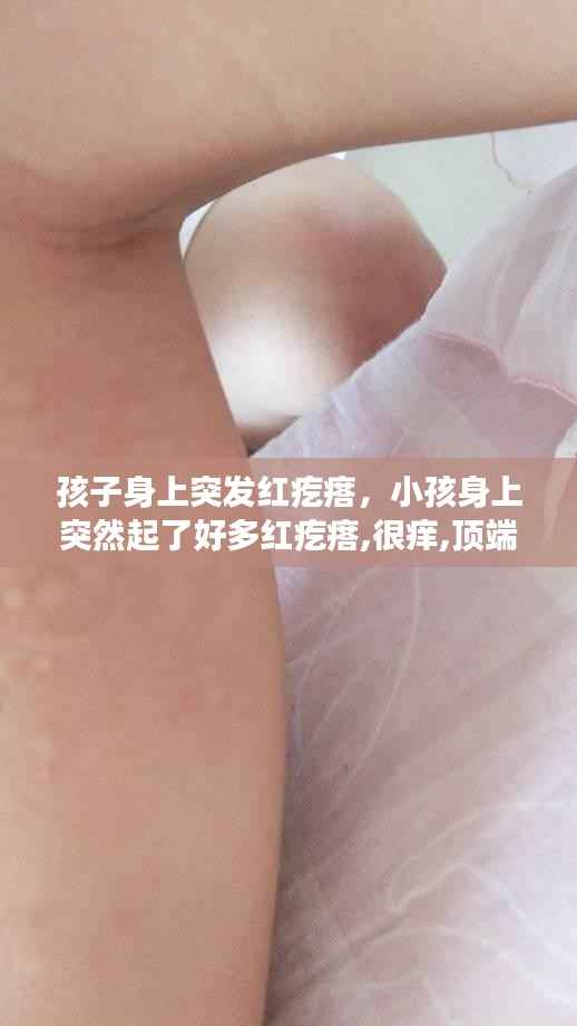 孩子身上突发红疙瘩，小孩身上突然起了好多红疙瘩,很痒,顶端硬的 