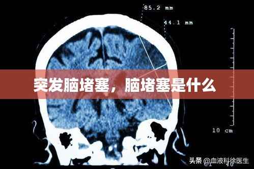 突发脑堵塞,脑堵塞是什么