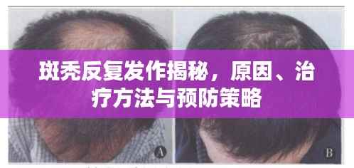 斑秃反复发作揭秘，原因、治疗方法与预防策略